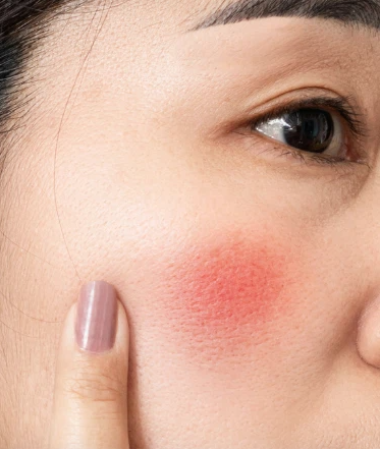Viêm da dị ứng là gì? Nguyên nhân gây bệnh và nguyên tắc phòng ngừa